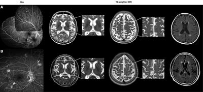 Magnetic Resonance Imaging-Visible Perivascular Spaces in the Basal Ganglia Are Associated With the Diabetic Retinopathy Stage and Cognitive Decline in Patients With Type 2 Diabetes